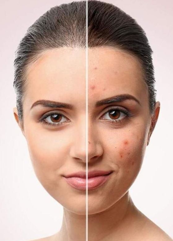 Acne & Scar Treatment